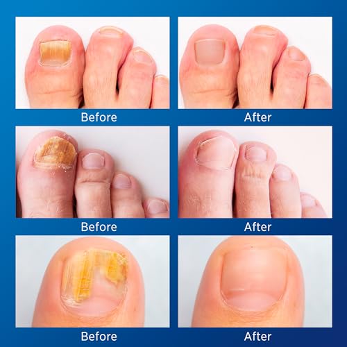 Toenail Fungus Treatment Extra Strength: (Small) 32 Patches with Hydrogel for Overnight Repair Fungus Nail Treatment For Toenail - Nighttime Nail Patches Visible Results in 8 Hours