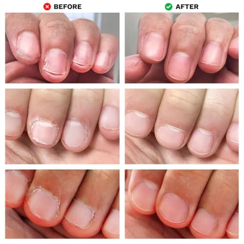 LONDONTOWN No Bite Nail Recovery - Nail Biting Thumb Sucking Deterrent - Bitter Non Toxic Nail Polish Treatment for Kids Adults - Fortified Strengthener and Growth Care Formula .40fl oz