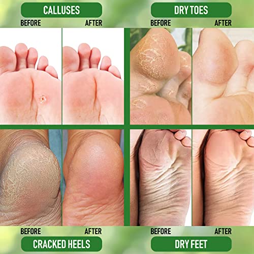 Urea 20% Healing Cream 4 oz - Best Callus Remover - Moisturizes and Rehydrates Hands, Feet and Knees to a Healthy Appearance - Soothes and Softens Thick, Cracked, Rough Dead and Dry Skin