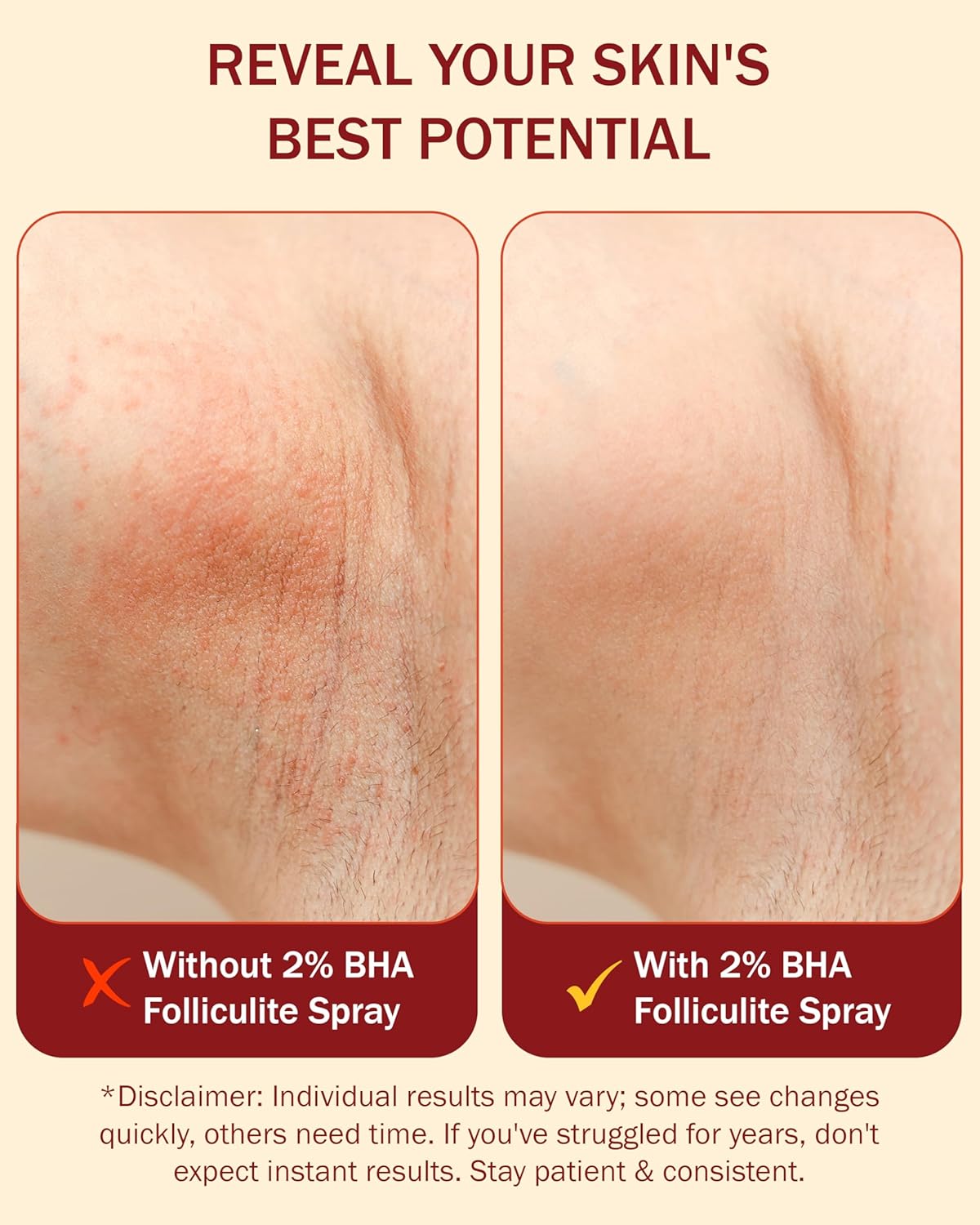 Folliculitis Treatment 2% BHA Body Spray - Salicylic Acid with Tea Tree Oil & Aloe Vera - Spray Moisturizer for Dry Skin, Clogged Pores & Irritation by Made in USA e70, 4 fl. oz