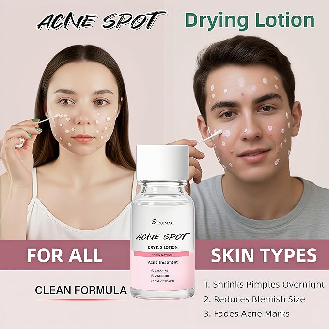Premium Acne Spot Drying Lotion Kit with Swab, Overnight Acne Treatment For Face, Dry Out Pimples, Blemishes, Zits And Clean Pores, 12ml / 0.41 FlOz